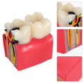thumbnail image 3 of Caries Tooth Teaching Model: Decay Teeth Comparative Study Model Caries Bilateral Learning Teaching Tools for Patient Education, 3 of 3