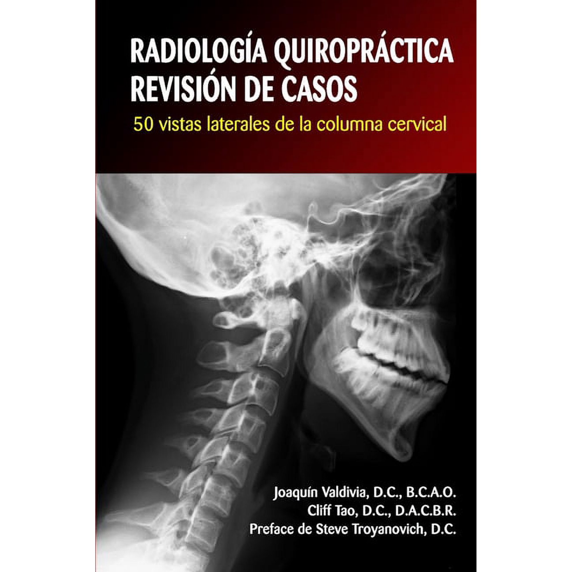 Radiología Quiropráctica: REVISIÓN DE CASOS. 50 vistas laterales de la columna cervical (Paperback)