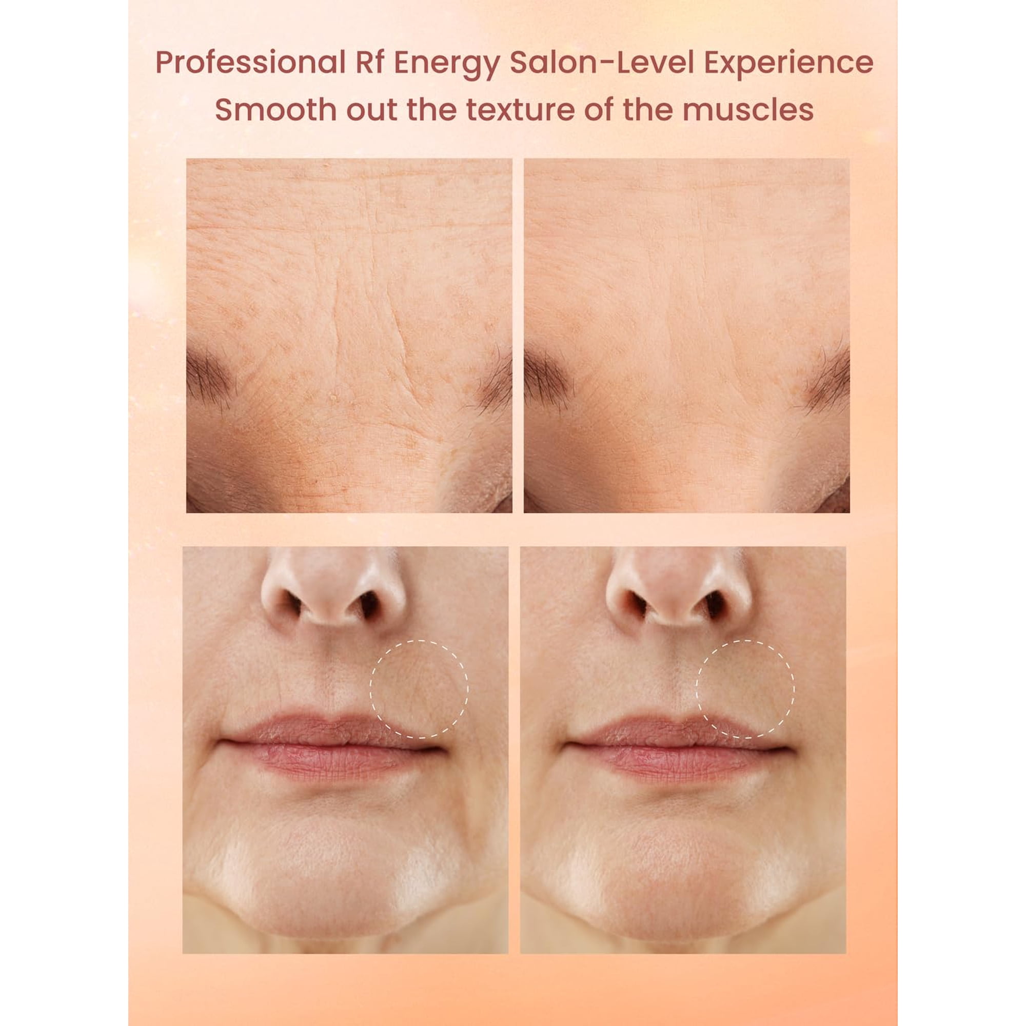 Appareil De Soin Visage 2EN1 RF Fractionné - Raffermissant, Anti-rides, Micro-aiguille