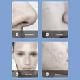 thumbnail image 2 of Facial Oxygen Injector 3 Gears 6 Suction Heads Vacuum Negative Pressure Blackhead Removal Machine, 2 of 5