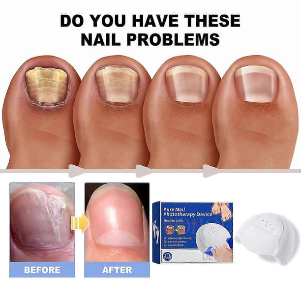 Nail Fungus Laser Treatment Device Portable Painless Nail Fungus Treatment Device for Men Women Nail Treatment
