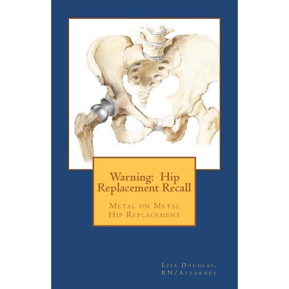 Warning: Hip Replacement Recall: Warning: Hip Replacement Recall Metal on Metal Devices Paperback 1461042356 9781461042358 Lisa G. Douglas