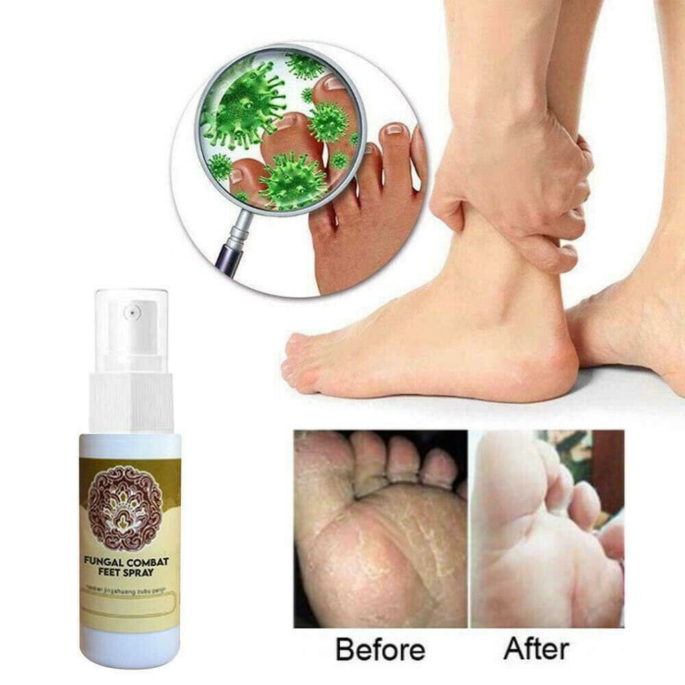 Natural Herbal Fungus Combat Feet Spray Anti Fungal Infections Athlete's Foot 60ml