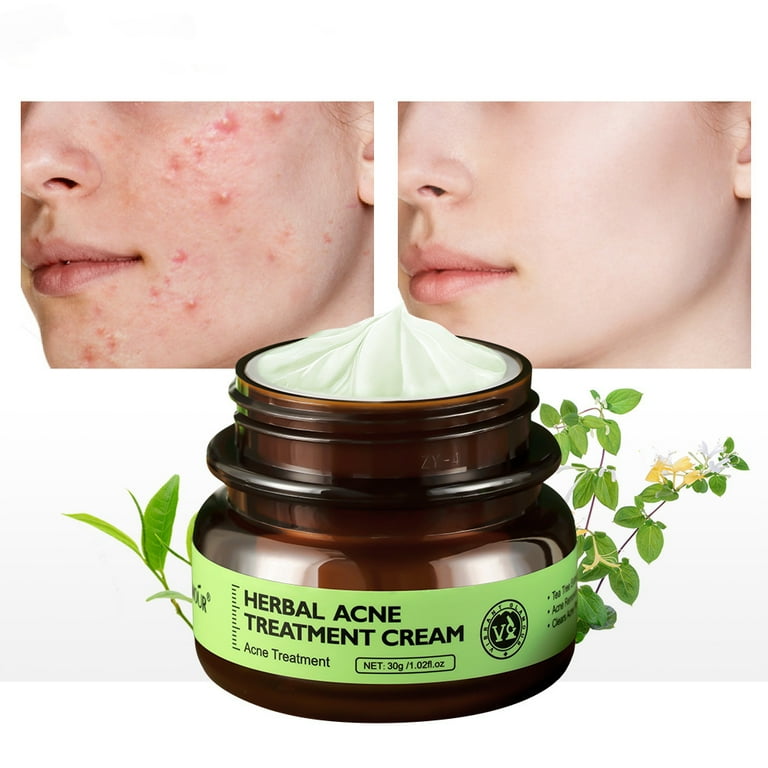 3 Pack Herbal Acne Treatment Cream Acne Cream Extra Strength Natural Herbal Acne Spot Treatment for Face