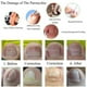 thumbnail image 5 of 10x 3.5mm Ingrown Toenail Straightening Clip Sticker Curved Brace Correction Sunnimix clip para enderezar las uñas de los pies, 5 of 8