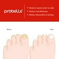thumbnail image 3 of Probelle Natural Fungal Nail Oil, 3 of 10