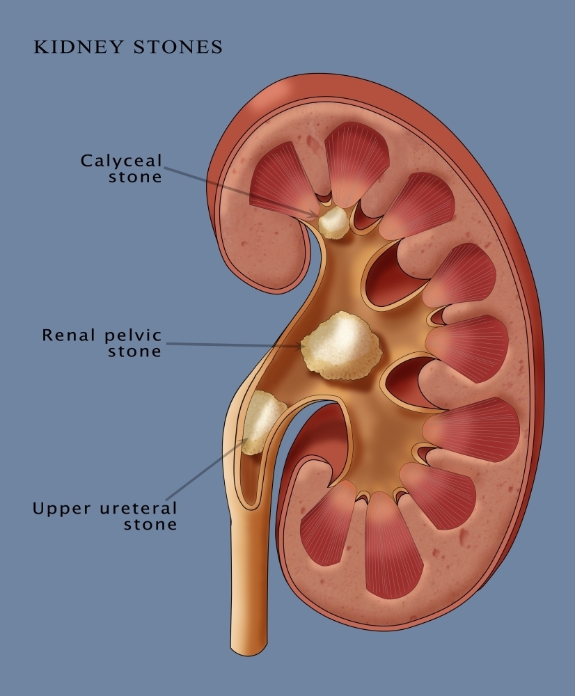 Kidney Stones Illustration Rolled Canvas Art - Monica SchroederScience