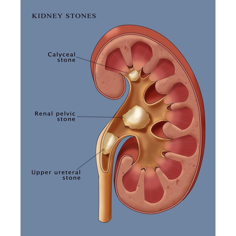 Renal stone guidelines picture