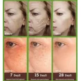 thumbnail image 5 of Crema blanqueadora para pecas, eliminador de Melasma y puntos negros, antimanchas marrones, aclara la pigmentación, hidratante, productos coreanos para el cuidado de la piel, 5 of 5