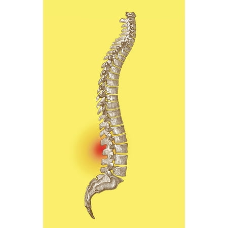Lower Back Pain Poster Print by Science Source