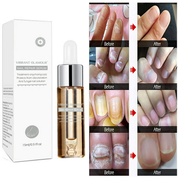 Vibrant Glamour Hand And Foot Nail Fungus Treatment 1 Fungal Nail Treatment  Feet Care Essence Anti Infection Paronychia Onychomycosis Gel New -  