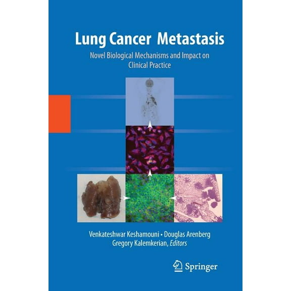 Lung Cancer Metastasis: Novel Biological Mechanisms and Impact on Clinical Practice, (Paperback)