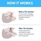 thumbnail image 2 of Advanced Anti-Snoring Mouthpiece - Double-Layer Night Guard for Men Women, Teeth Grinding & Sleep Apnea Relief, 2 of 5