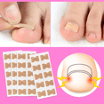 thumbnail image 4 of Parches De Corrección De Uñas Encarnadas 5 Blister Con 10 Parche C/u, 4 of 6
