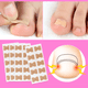 thumbnail image 4 of Parches De Corrección De Uñas Encarnadas 5 Blister Con 10 Parche C/u, 4 of 6