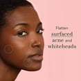 thumbnail image 5 of CYC Pimple Cover Hydrocolloid Patch For Face Blemishes Zits Absorbing Patch Breakouts For Skin Care Facial Sticker, 5 of 5