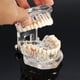 thumbnail image 3 of Consumibles dentales, modelo de restauración dental extraíble, modelo de diente patológico, modelo de diente móvil, modelo dental de implante, 3 of 4