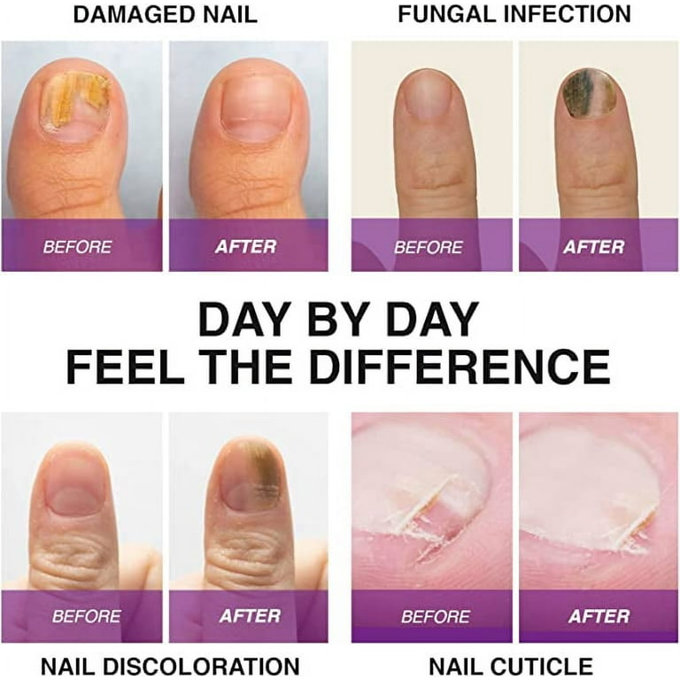 The best treatment 2024 for nail fungus