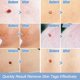 thumbnail image 4 of Remove Skin Tag Pen Facial Care Nevus Tool 2mm-4mm Remove Meat Nevus Corns Warts Skin Tag Removal Tool, 4 of 5