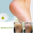 thumbnail image 4 of Pedicure Foot File Callus Remover Foot Rasp Professional Stainless Steel Callus File For Foot Care, 4 of 5