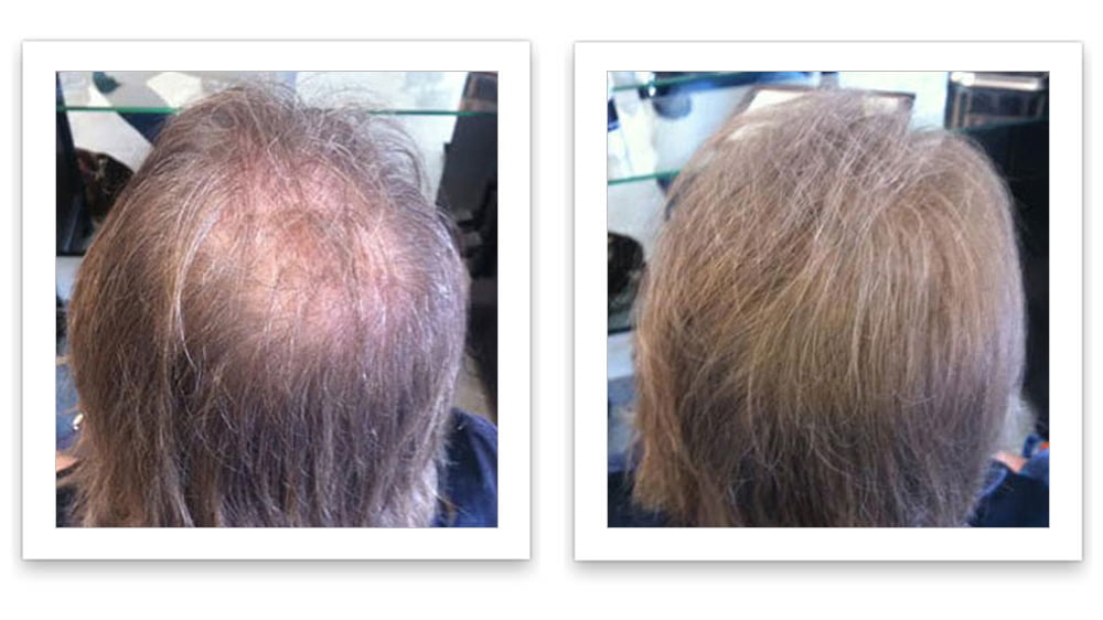 Febron Hair Building Fibers 30g (MEDIUM BROWN) - Hair Loss Concealer For  Thinning Hair 