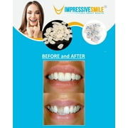 Impressive Ultra Thin Tooth Whitening Veneers Choose Shade A-1