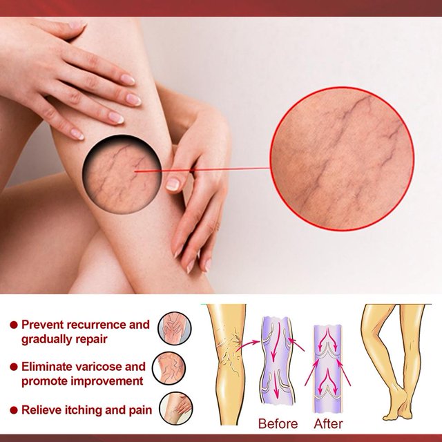 Parche eficaz para el alivio de las venas varicosas Cuerpo Pierna Vasculitis Flebitis Araña JShteea Cuidado Belleza