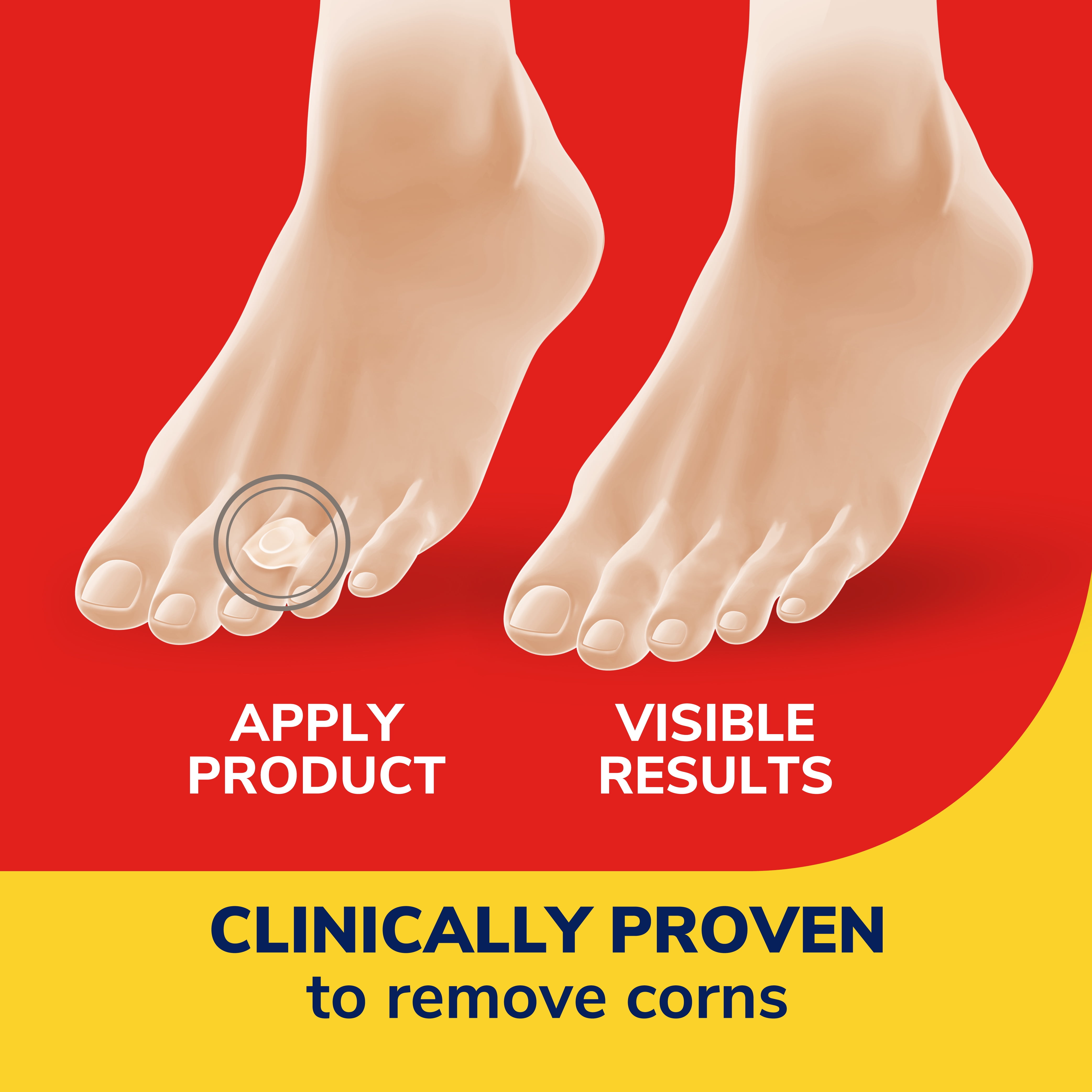 Dr. Scholl's One-Step Corn Remover Cushion Strips, 6 Count, Maximum Strength