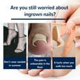 thumbnail image 6 of Nail Patches,Ingrown Toenail Correction Treatment Tool, No Glue 50Pcs Ingrown Toe nail Corrector Patch, Professional Ingrown Toenail Sticker, 6 of 8