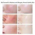 thumbnail image 3 of Anti Red Facial Cream, Anti Red FaceCream Promotes Skin Regeneration  For Home, 3 of 8