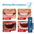 thumbnail image 6 of Discount Bonanza, Flawles Teeth Whitening Pen, Gel Pen, Stain Remover, Breath Freshener, Oral Care, Dental Beauty, For Daily Use Up to 30% OFF | Plastic, Multicolor, Acppild, 6 of 8