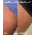 thumbnail image 3 of Targeted Exfoliating Serum, Eliminate Ingrown Hairs, Razor Bump Serum, 3 of 5