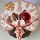 thumbnail image 2 of Modelo de Enfermedad del Cerebro Humano - Patología Cerebral Hemorragia del Encefálico Modelo de Enseñanza Médica - Modelo de Anatomía del Cerebro Humano, 2 of 5