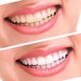 thumbnail image 3 of Professional Teeth Whitening Kit 44% Carbamide Peroxide 10 Pcs Syringes Gel + 2 Pcs. Thermoform Trays + 1 Pcs. Bonus White Light, 3 of 9