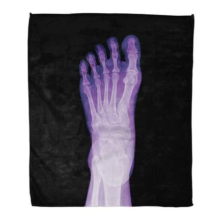 SIDONKU Throw Blanket Warm Cozy Print Flannel Blue Foot X Ray Human Ankle Arthritis Top View Red Pain Comfortable Soft for Bed Sofa and Couch 50x60