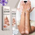 thumbnail image 2 of Vitiligo Relief Cream, Natural Cream For Vitiligo Treatments, Portable Anti-itch Body Care Cream Skin Care Products, 2 of 5