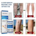 thumbnail image 2 of EELHOE intravenous massage spray relieves pain in veins and leg blood vessels and smoothes earthworm legs Massage Oil1PCS), 2 of 5