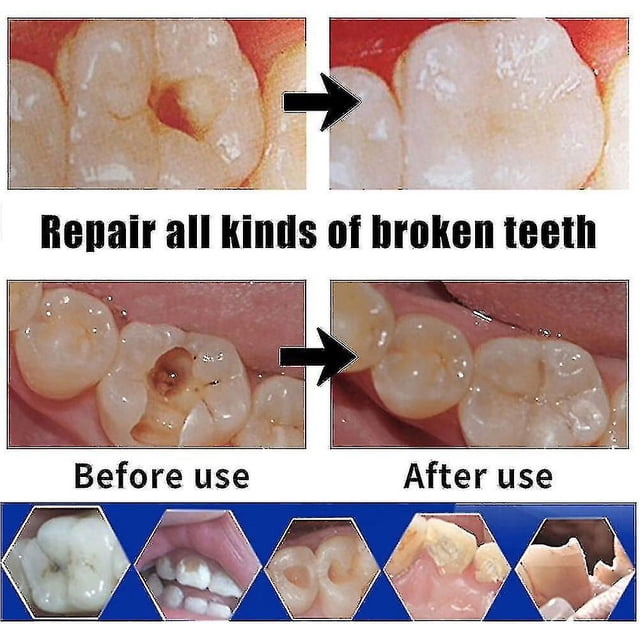 Pegamento para reparar espacios entre dientes, dientes postizos, kit de relleno dental, pegamento para dientes postizos temporales
