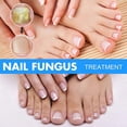 thumbnail image 4 of Fungal Nail Repair Treatment Hand & Foot Grey Nail Care Repair Grey Nail Solution Anti-Fungal Liquid for Thickened Yellow Nails, 4 of 5