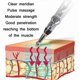 thumbnail image 3 of Acupunctur, 3 of 5