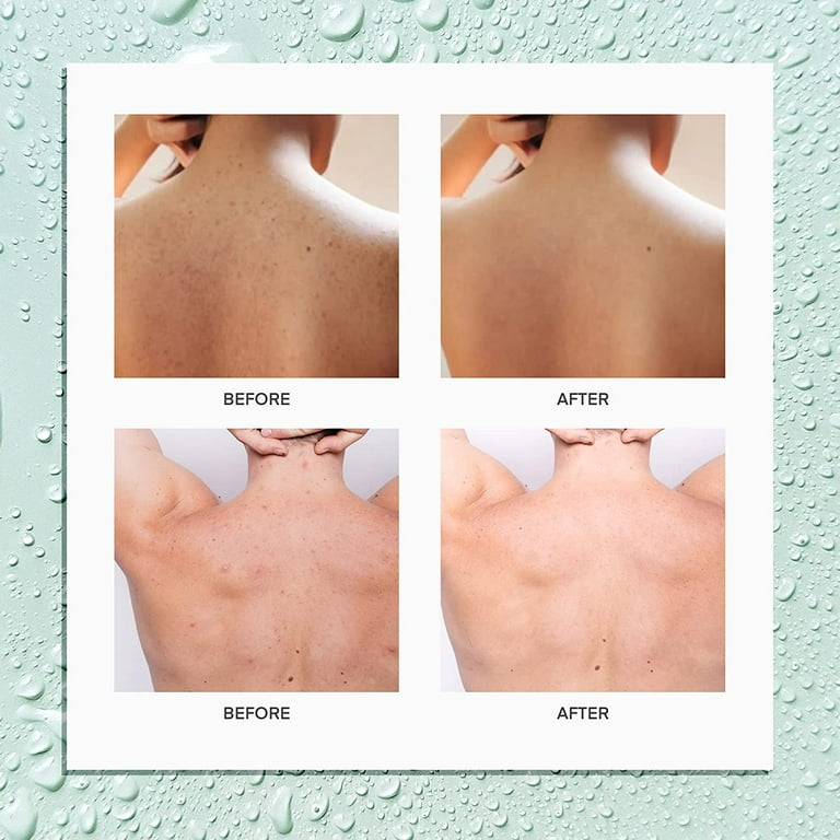 Tea tree oil for back acne deals