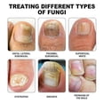 thumbnail image 3 of Fungus Laser Therapy Device, Light Therapy Device Fungal Nail, Revolutionary High-efficiency Light Therapy Device For Toenail Diseases -gsl, 3 of 5