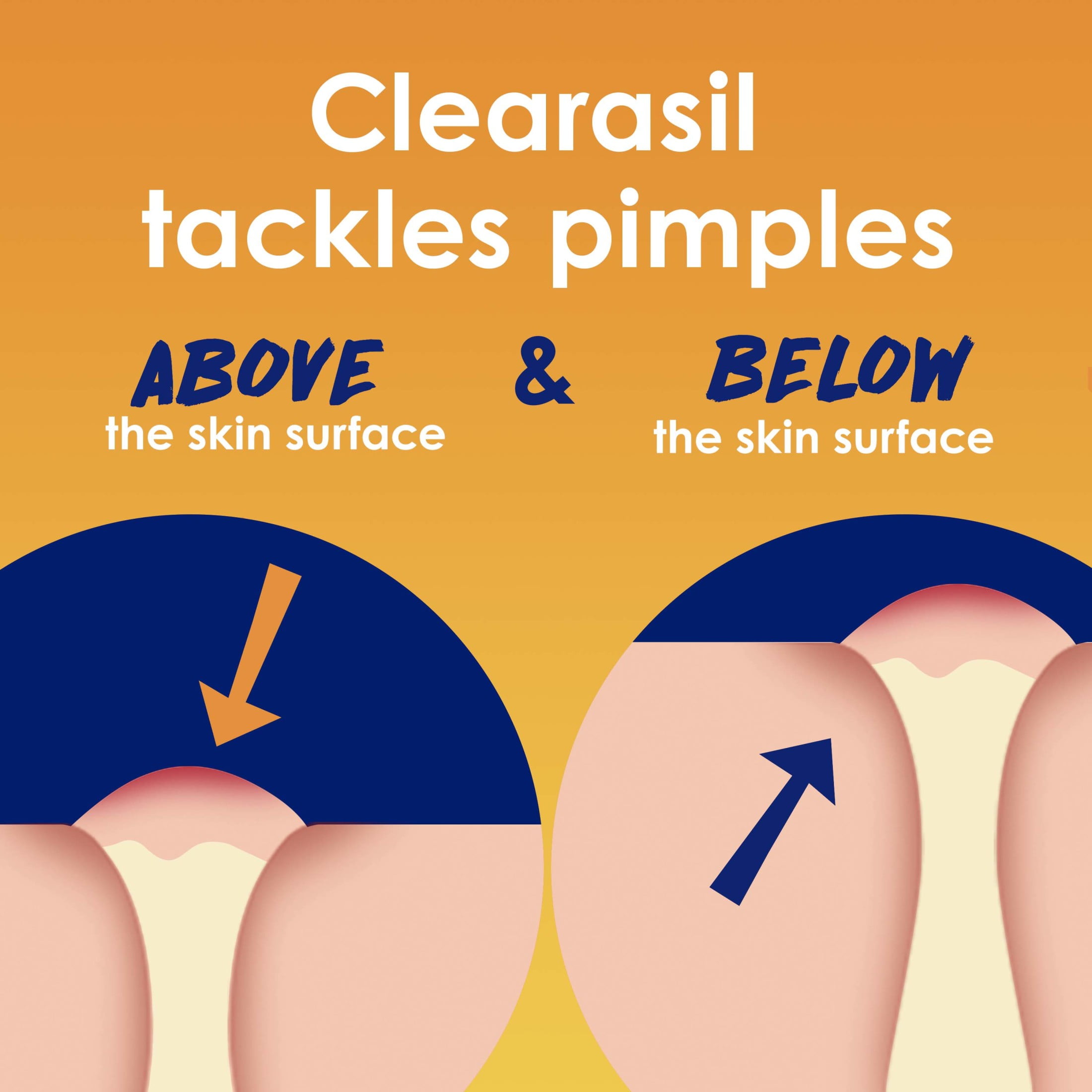 Clearasil Benzoyl Peroxide Stubborn Acne Spot Treatment Cream, 1 oz