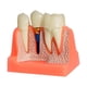thumbnail image 5 of Modelo de implante,Modelo de implante para la educación del paciente,Presentación con puente coronal removible,Práctica de enseñanza con modelo dental 4 veces,Clase de demostración, 5 of 9