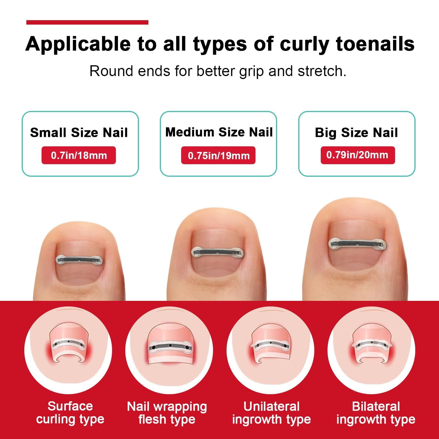 Unimiko Ingrown Toenail Corrector Kit & Curved Nail Repair : Quick & Easy Solution - 6 Pcs (0.71/0.75/0.79in) for Effective Treatment