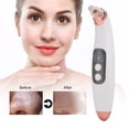 thumbnail image 3 of Electric Pore Cleanser, One Button Switches Fast Charging USB Interface Remove Blackheads Instrument  For Skin, 3 of 8