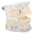 thumbnail image 2 of Modelo de enseñanza de dientes Modelo de patología Modelo patológico Estudio de enseñanza dental Modelo de dientes de demostración para laboratorio dental Investigación hospitalaria Dientes anatómicos, 2 of 9