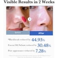 thumbnail image 5 of Medicube Exfoliating Pads 2.0 Zero Pore Dual-Texture Facial Toner with Lactic Acid Salicylic Acid for Pore Minimizing Korean Skin Care 70 Units All Skin Makeup&nbsp;Organizers, 5 of 8