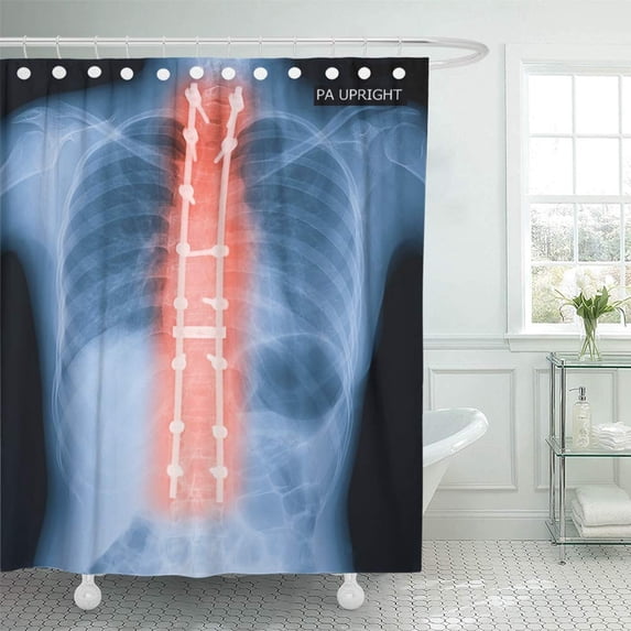 KSADK X Ray of Adult Patient Spine Show Scoliosis Surgery Fix by Long Metal Rod and Many Shower Curtain 66x72 inch