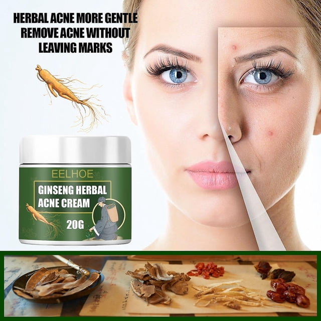 Crema para el acné HUOGUO Ginseng Herbal Desalt, reparadora de cicatrices, 10-50 g